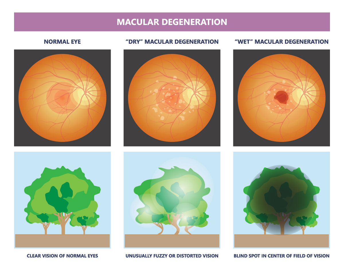 Age Related Macular Degenration Symptoms