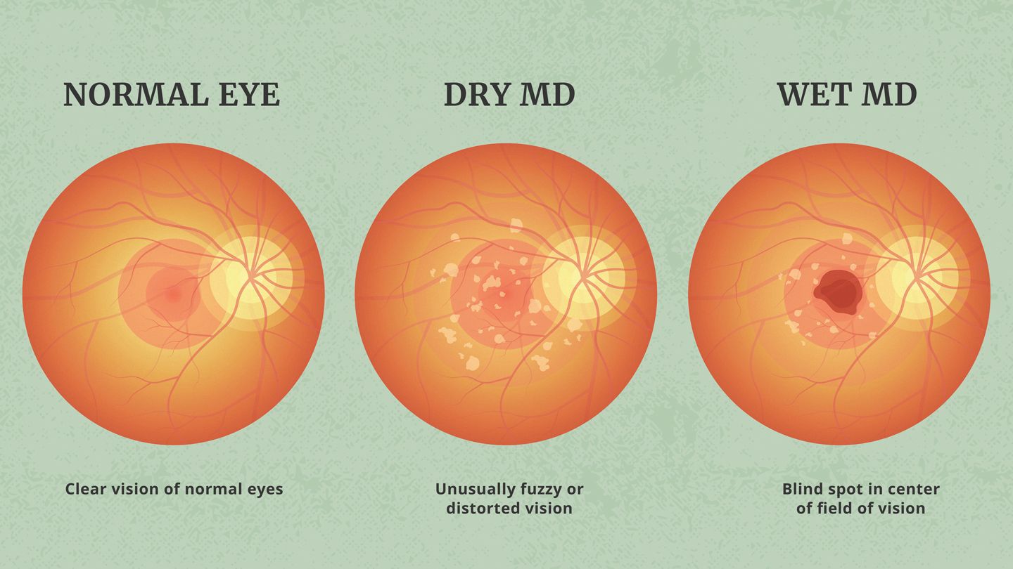 Types of Age Related Macular Degenration