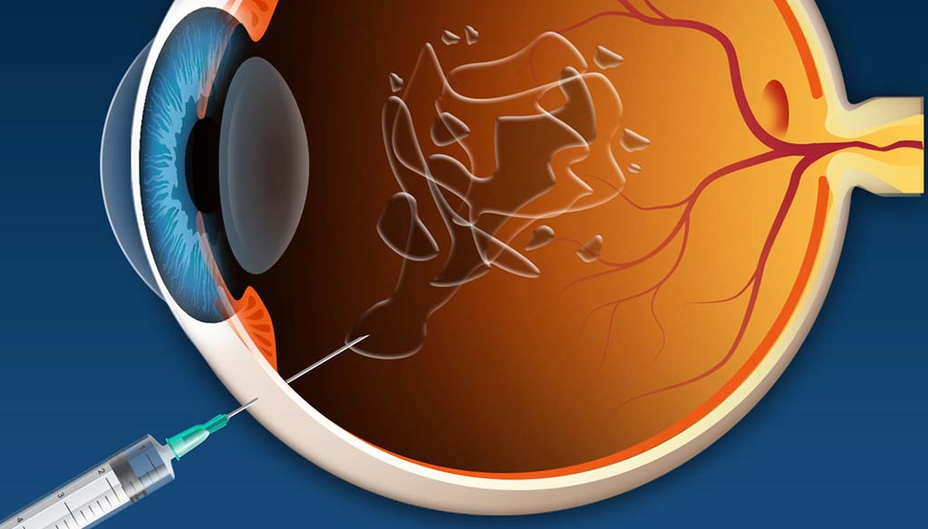 Intravitreal Injection Illustration