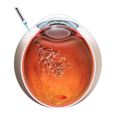 Intravitreal Injection Illustration