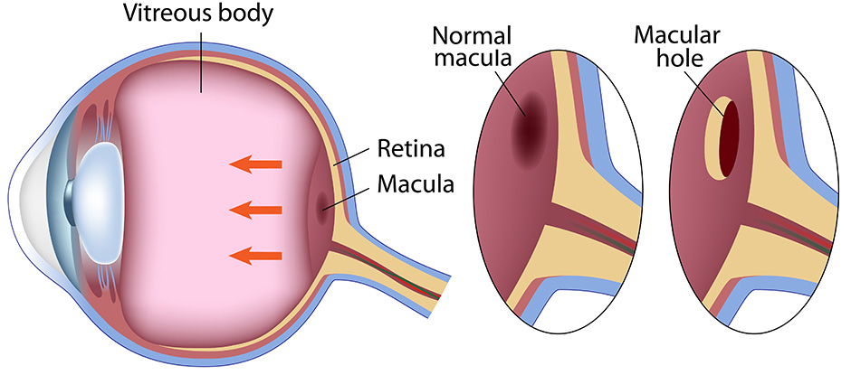 Macular Hole Surgery Illustration