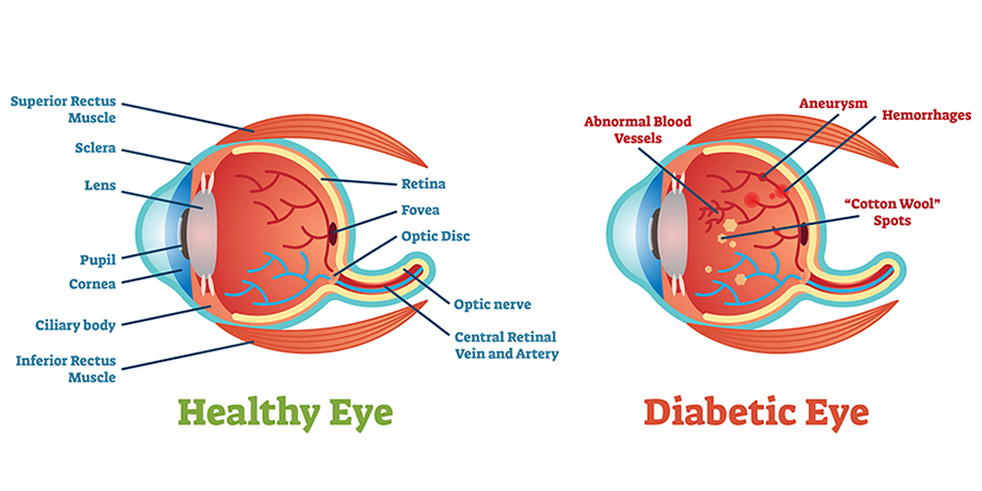 Healthy Eye vs Diabetic Eye Symptoms