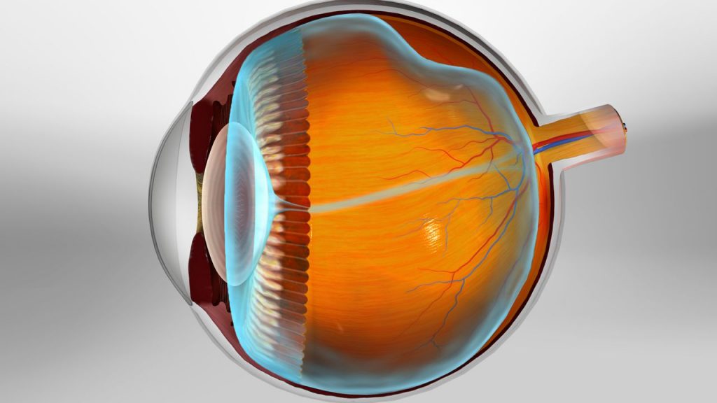 Posterior Vitreous Detachment Illustration