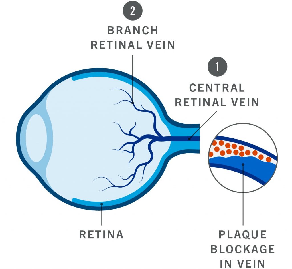 Retinal Vein Occlusion in Dubai