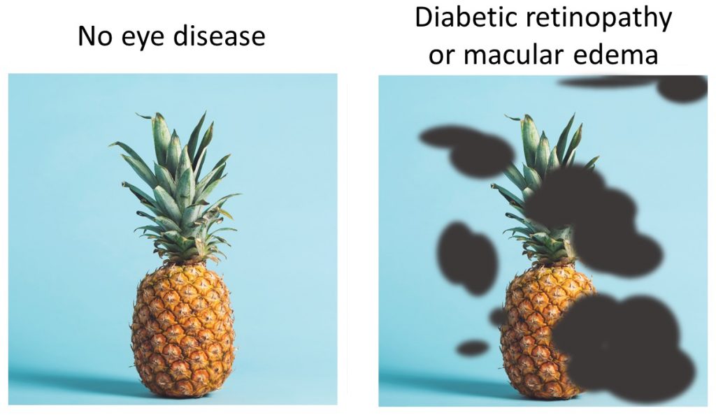 Good Vision vs Diabetic Retinopathy or Macular Edema