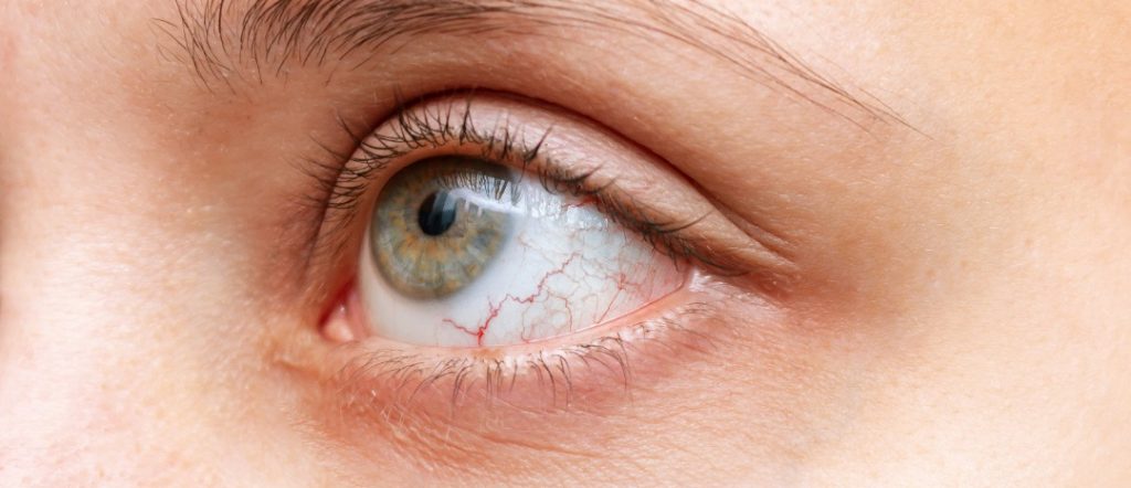 UVEITIS Treatment in Dubai