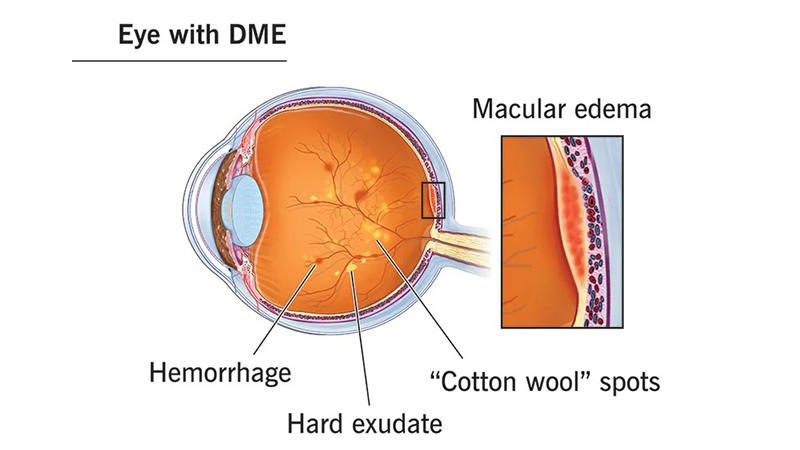 Diabetic Macular Edema DME Representation