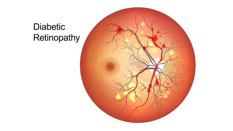 Diabetic Retinopathy Illustration