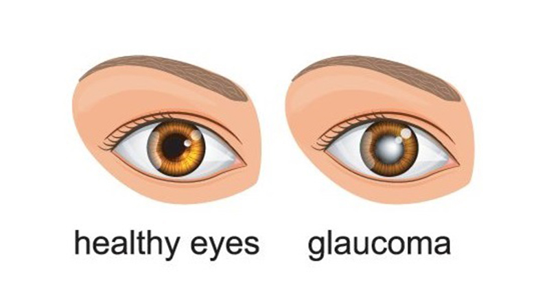 Normal Eye vs Glaucoma & Glaucoma Symptoms