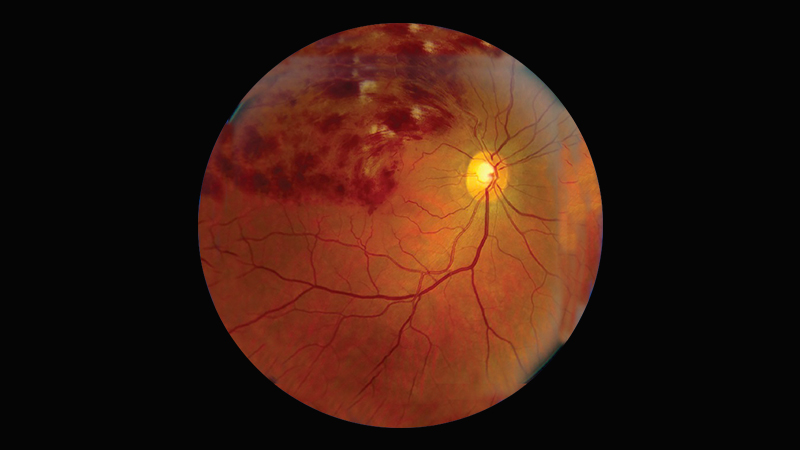 Retinal Vein Occlusion symptoms